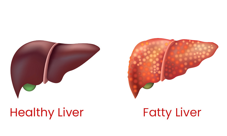 Early Common Signs of Fatty Liver Disease 3126
