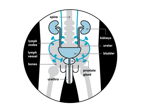 prostate  cancer
