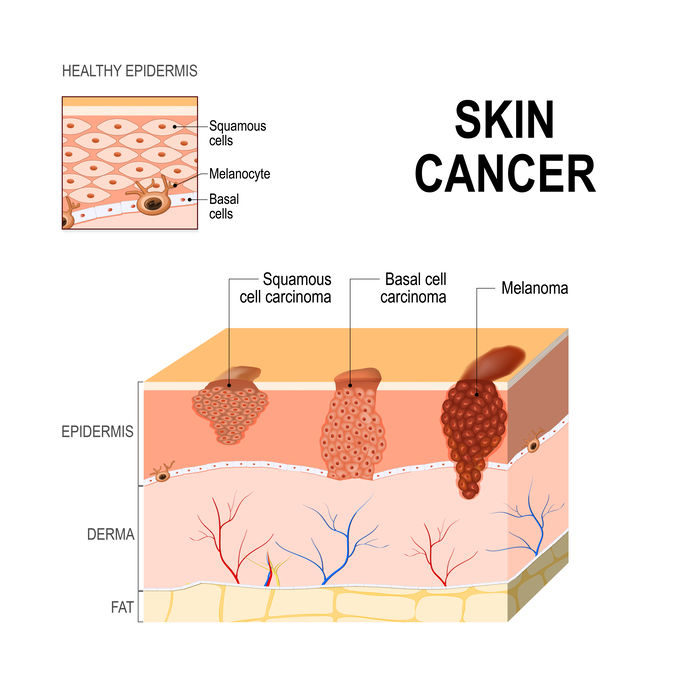 Skin Cancer:  04 types of skin cancer, Best Prevention, Early Detection, and Modern Treatment