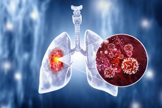 Lung Cancer: 9 Ways of Cancer Symptoms, Causes, Diagnosis, Treatment, Prevention, and the Latest Medical Advances
